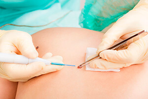 Cirurgia Dermatológica São Paulo - Remoção de lesões de pele e câncer